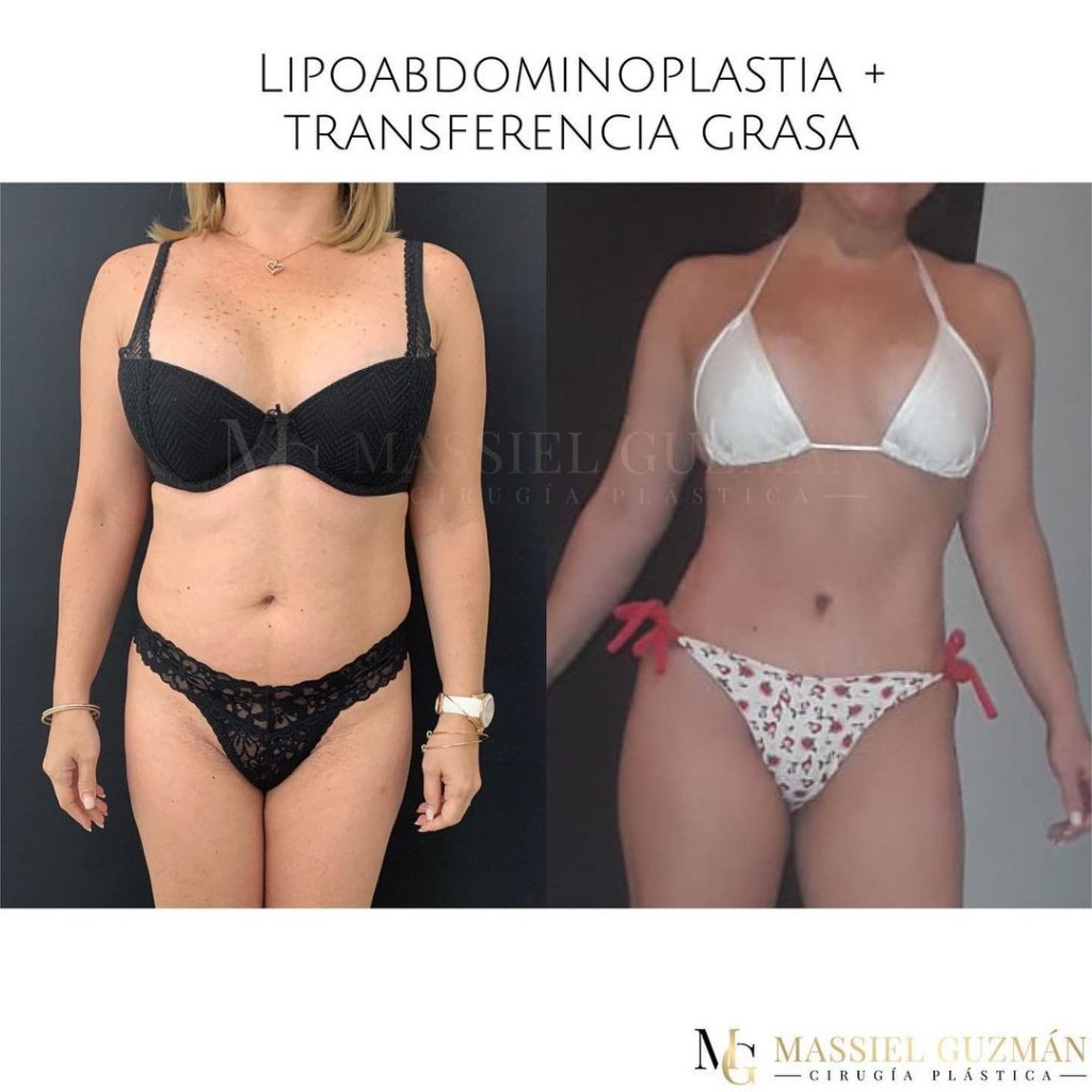 Lipoabdominoplastia más transferencia de grasa Dra Massiel Guzmán