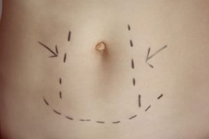 Abdominoplastia Mini