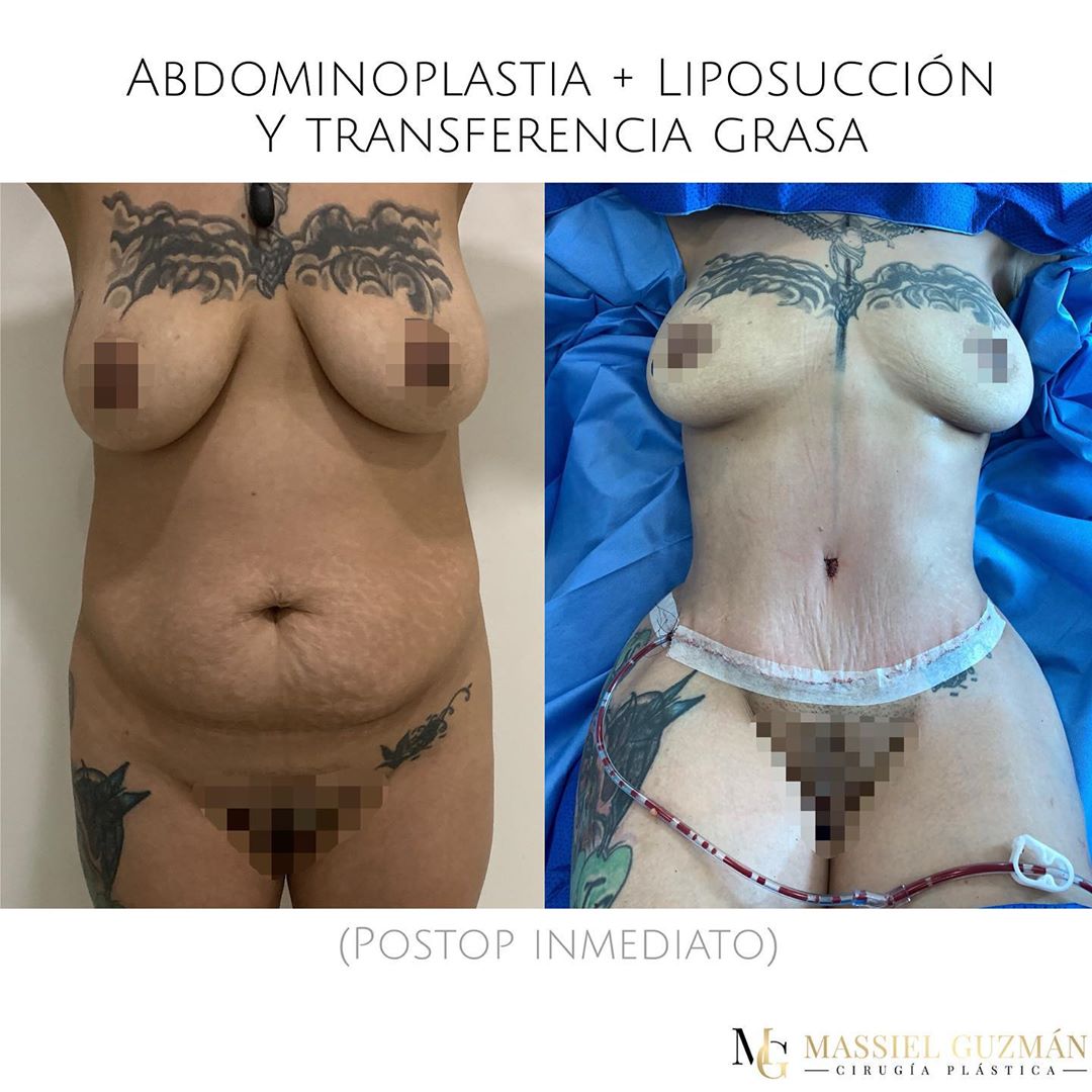Tummytuck + Liposuction + Fat transfer