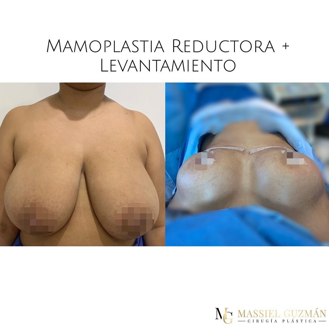 Breast Reduction & lift!