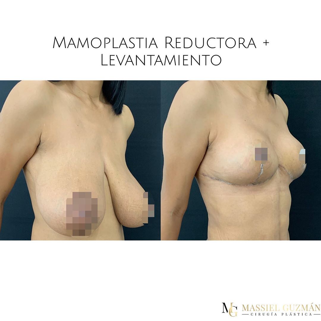 Breast Reduction + Lift