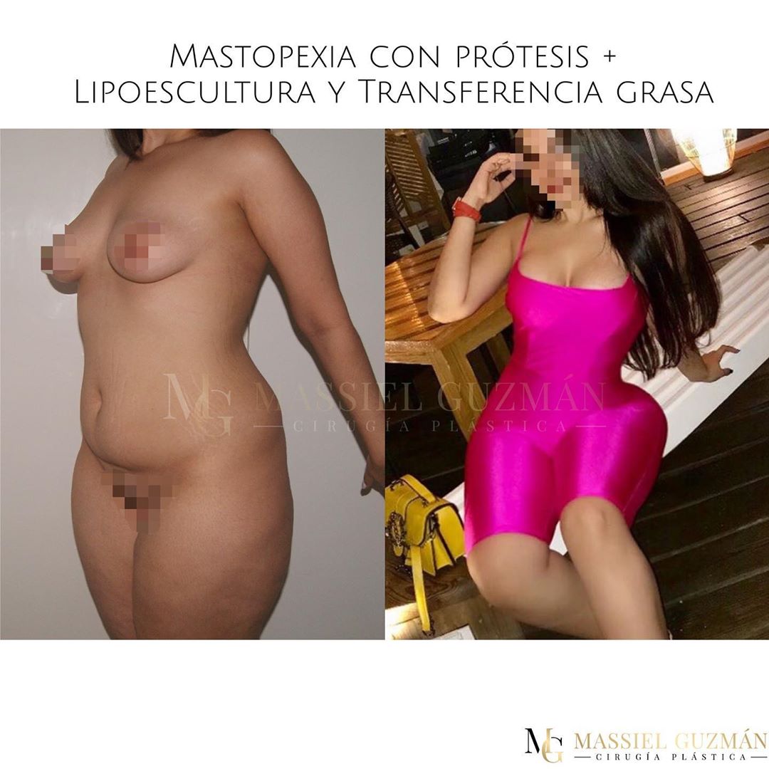 Breast Lift with Implants + Liposculpture and fat transfer