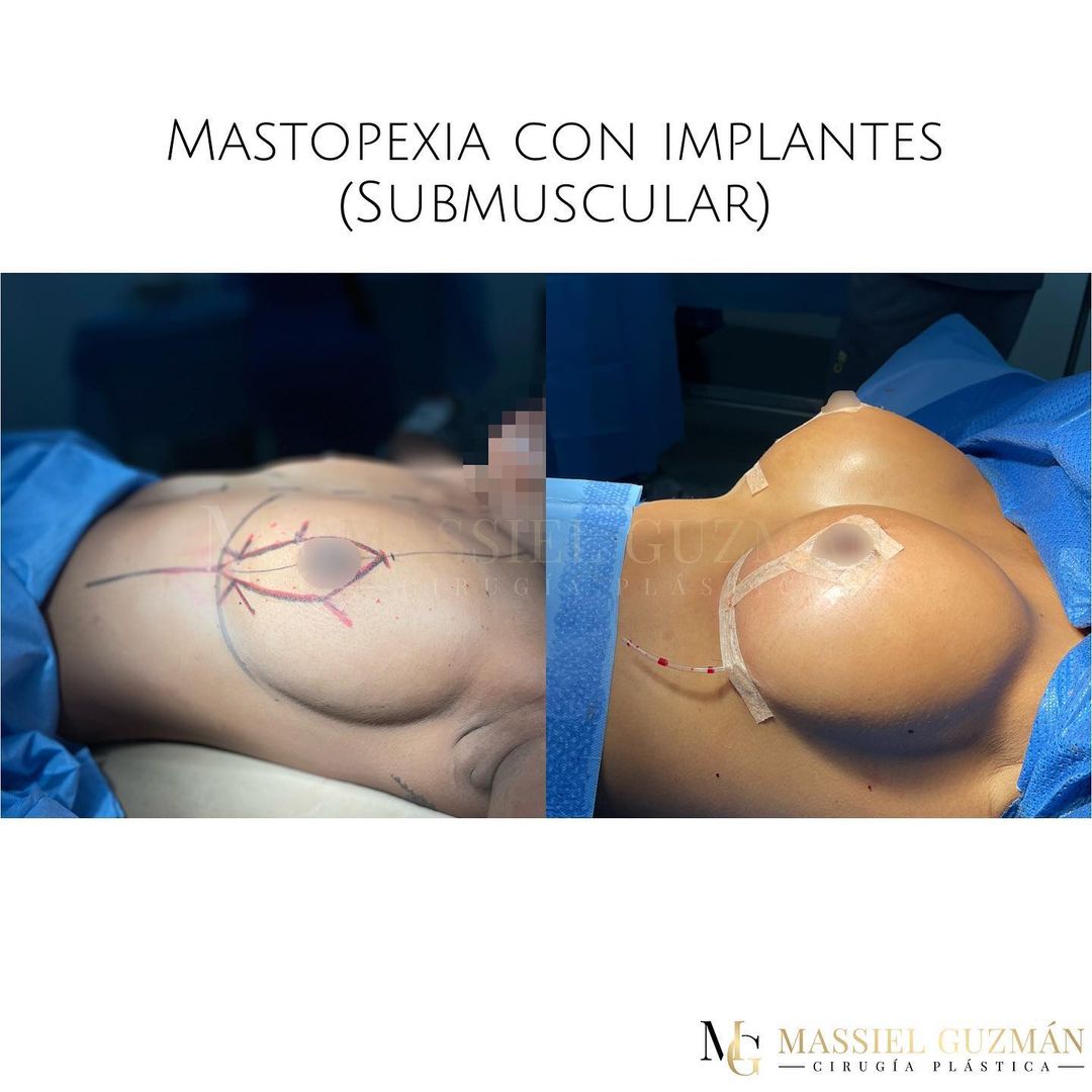 Mastopexia con implantes