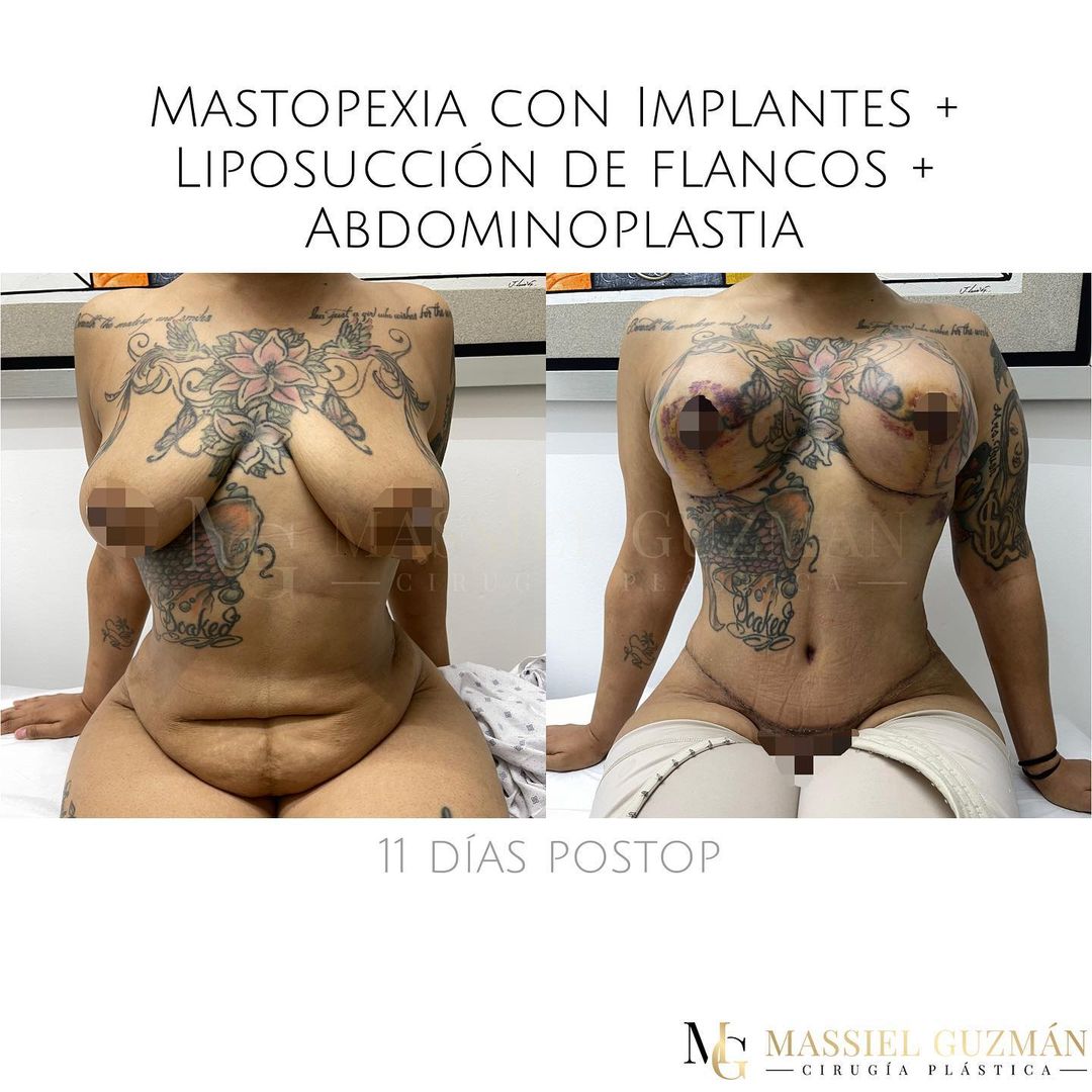 Mastopexia con implantes, Liposucción de flancos, Abdominoplastia
